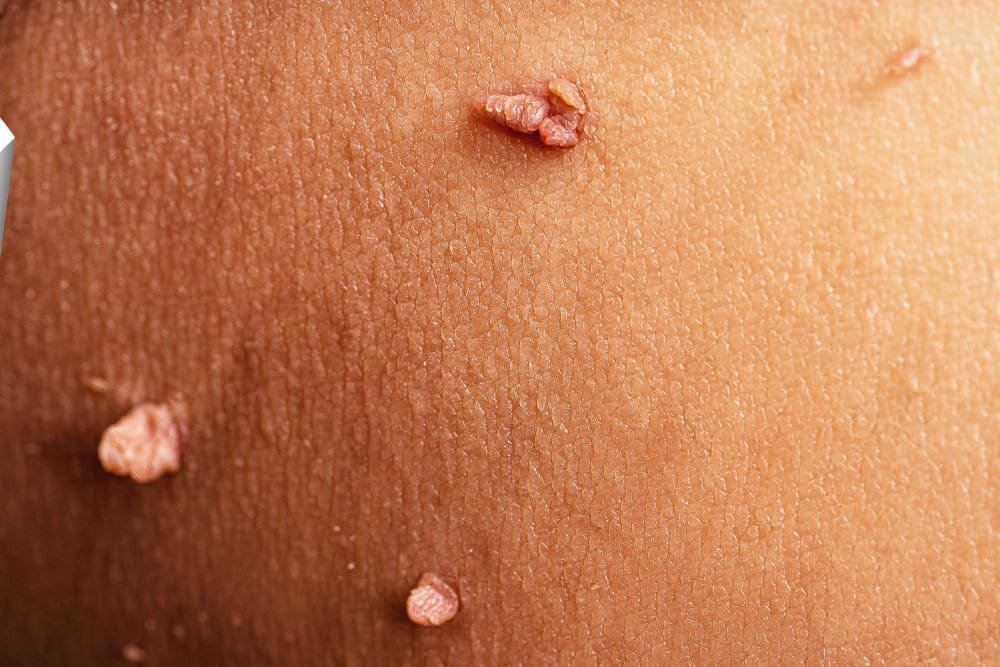 Tratamiento de enfermedades de transmisión sexual en Jalisco: Atención médica confidencial y especializada